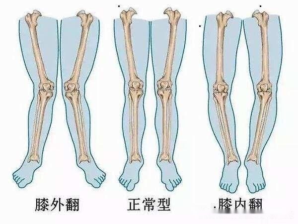 辟谣：走路外八字可以矫正O型腿？别闹了，正确的矫正需要这3步