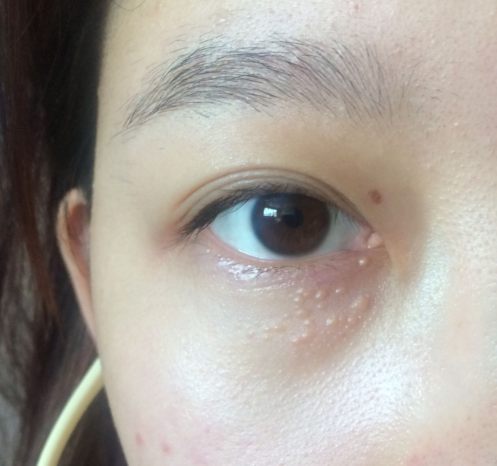 消除脂肪粒的五大方法