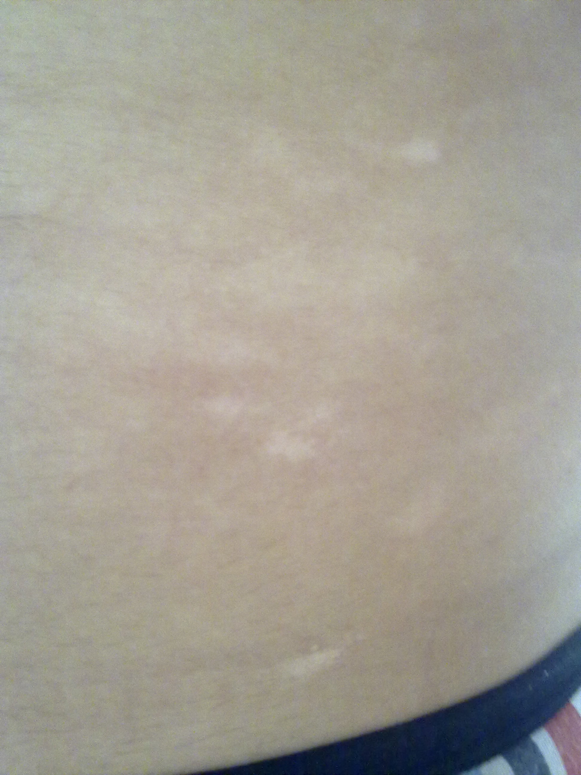 01白癜风:这是最常见的白斑,往往表现为瓷白色.