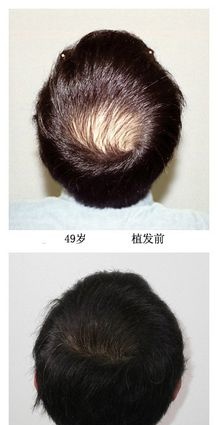 而在治疗过程中,很多患者存在误区,对脱发原因认识不清,盲目补肾,乱用