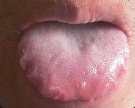 看舌头测试维生素b的缺乏