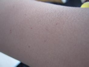 注意 血小板减少性紫癜出现的症状是这些