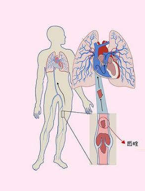 肺栓塞图片 示意图图片