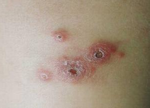 白塞氏病有哪些明显症状