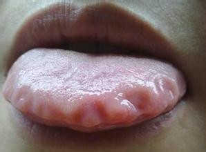 缺维生素b2的舌头图片图片