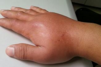 被马蜂蛰了怎么办