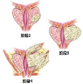 人体前列腺癌图片图片