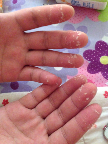 手指头脱皮是怎么回事