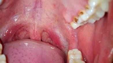 可以 先用勺柄压住 舌头 再有 照亮喉咙的 情况下 能看到 鱼刺 就用