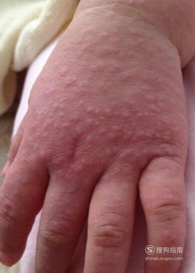 受风起疙瘩怎么解决