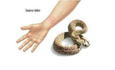 01蝎子蛰伤:蝎子尾巴上有一个尖锐的钩,与一对毒腺相通.