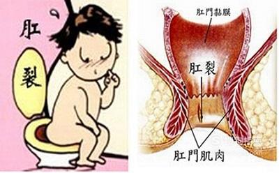 肛门肿痛是怎么回事