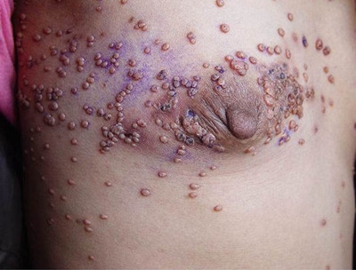 艾滋病的早期症状