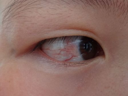 玩手机对眼睛的伤害很大,以至于会在眼睛里看见红血丝的存在