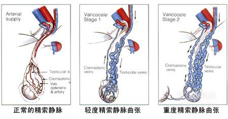 精索静脉曲张的症状有哪些