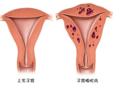 关于子宫腺肌病的常见问答