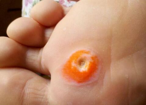 脚上长了鸡眼怎么办