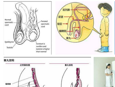 急性睾丸扭转的诊断思路有哪些?