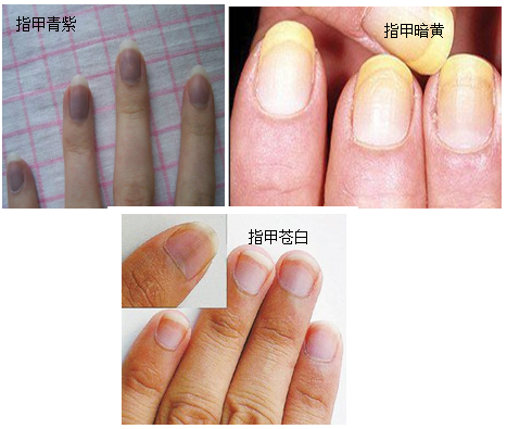 指甲颜色健康对照图片