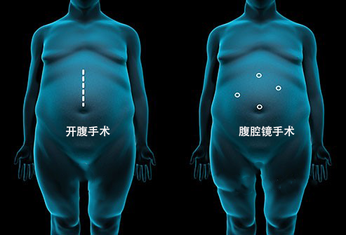 手術減肥方法有哪些？