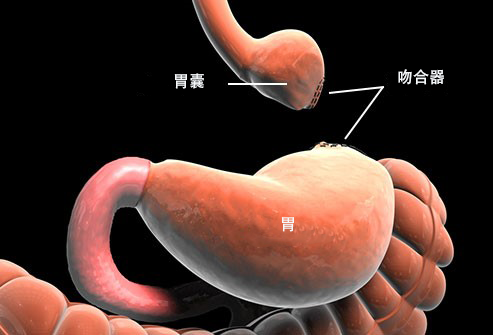 手術減肥方法有哪些？