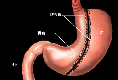 手術減肥方法有哪些？