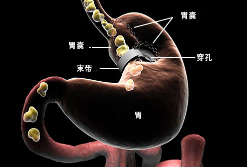 手術減肥方法有哪些？