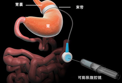 手術減肥方法有哪些？