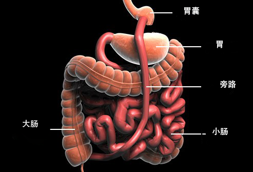 手術減肥方法有哪些？
