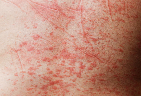 感染登革热后,患者会出现皮疹,发烧,头痛,容易淤青和牙龈出血等问题.