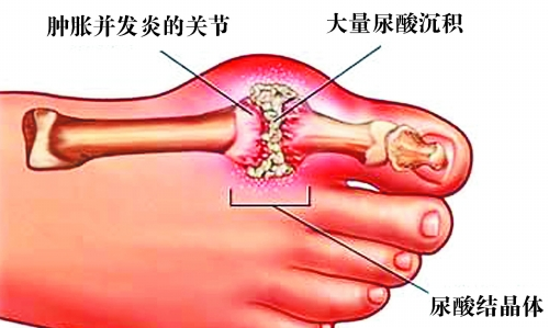 01脚痛风发作时剧烈的疼痛会给患者带来了很大的影响,常常令患者无法