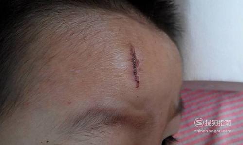 头撞了个大包怎么办