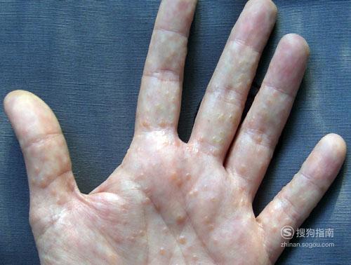 手起汗疱疹怎么治疗?