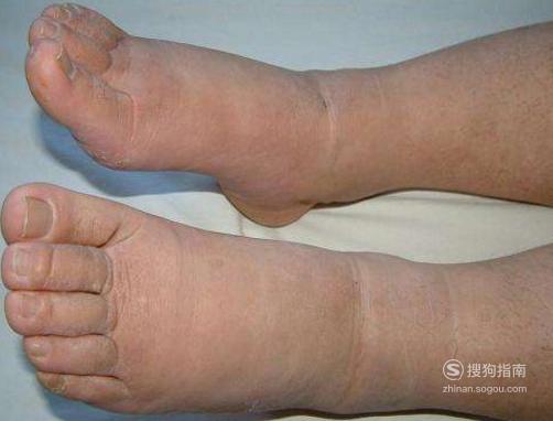 水中毒了会表现出哪些症状?