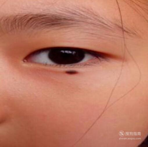 怎么区分黑色素瘤和痣