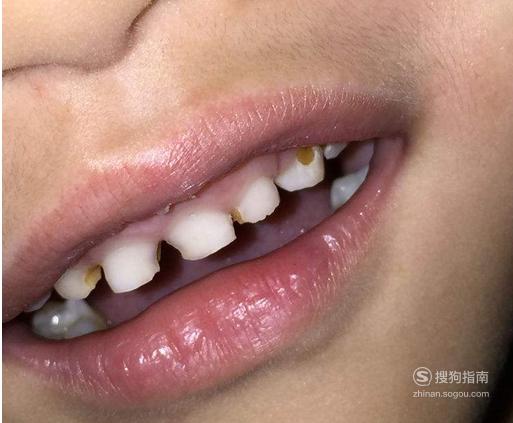 导致孩子晚上睡觉出现磨牙的原因有哪些?