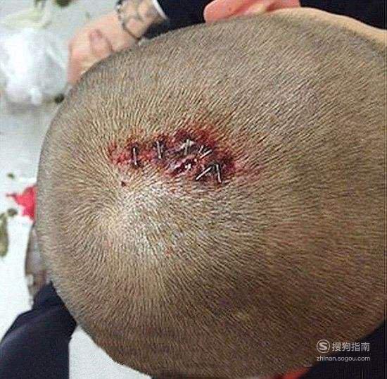 头部缝针后哪些食物不能吃