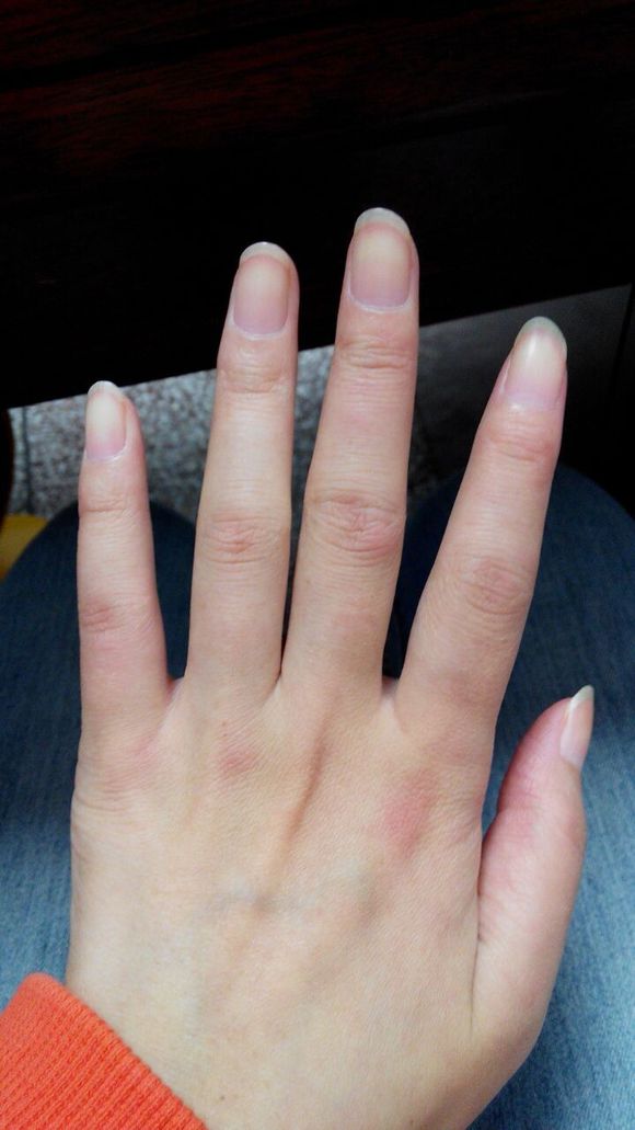 的以全身关节炎症改变为主的疼痛性疾病,小关节滑膜所致的关节肿痛