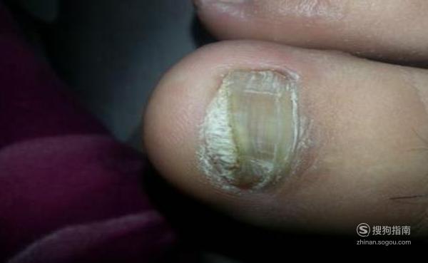 亮甲能治好灰指甲吗 亲身体会