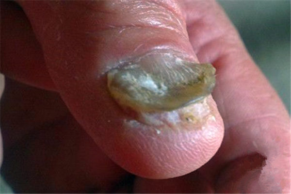 灰指甲是如何引起的
