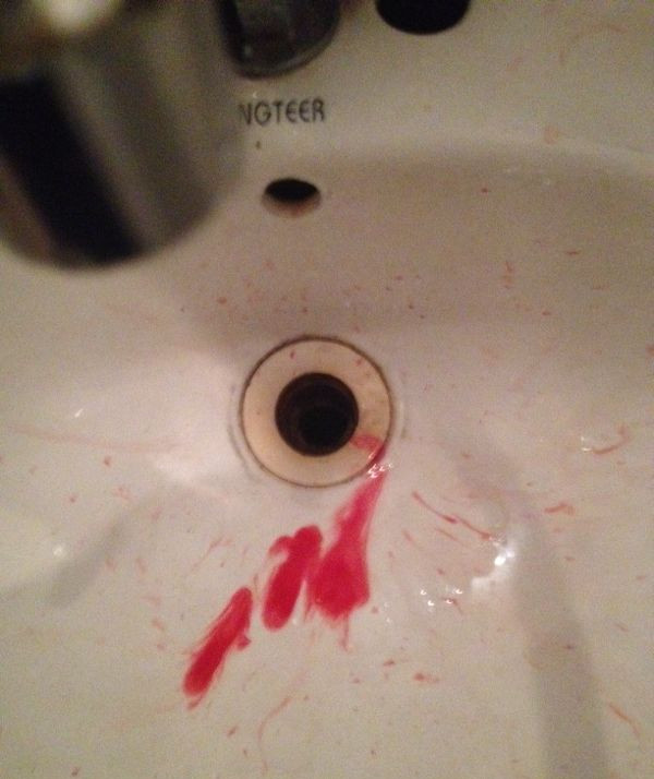 01咯痰中带有鲜红色血丝或者血块叫做咯鲜红色血痰,经常提示有呼吸道