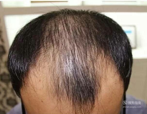 二级脱发,额部和颞部稍稍成倒三角后移,距外耳道大学2cm这种轻微脱发