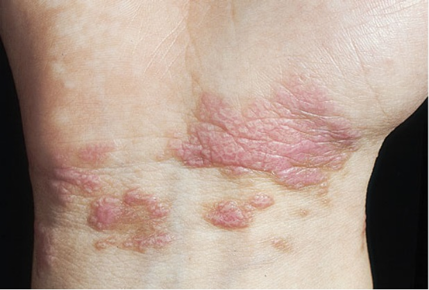 诱因还不清楚,但如果发现,应该去检查肝脏,因为这可能是丙肝的征兆.