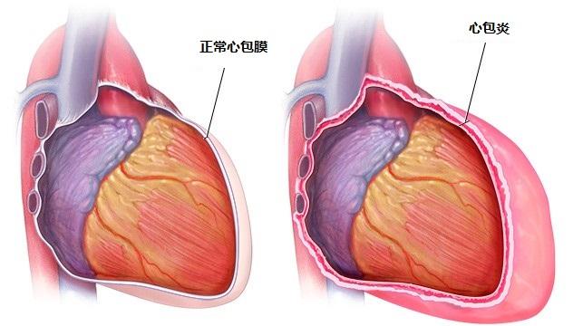 纤维素性心包炎图片图片