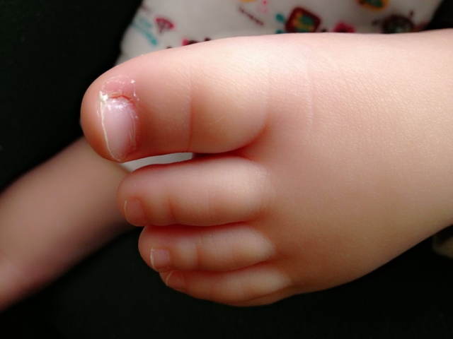 看看甲沟炎是怎么形成的