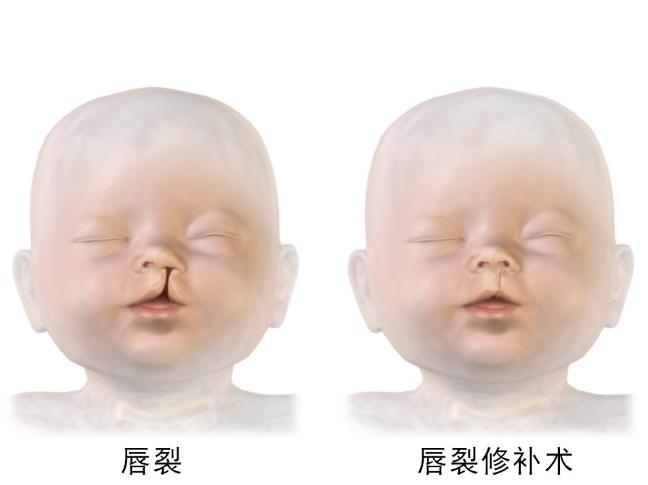 唇裂指上嘴唇分裂(通常正好在鼻下面),可破坏容颜,使婴儿不能闭合嘴唇