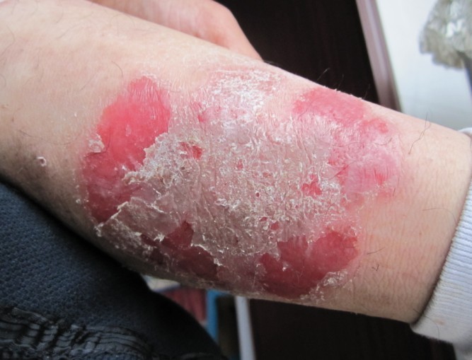 皮癣的真实图片