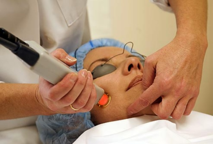 激光换肤术使用特殊的激光去除表层皮肤.