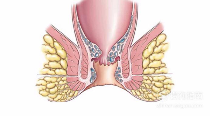 肛瘘初期的一些症状 步步深入 - 青涩博客