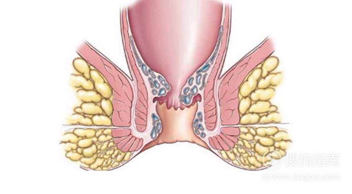 肛瘘的前兆图片